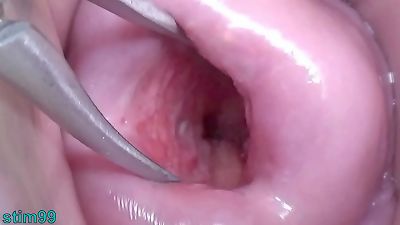 asian wife Open Cervix broad to witness inside Uterus